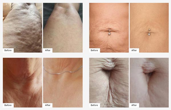 Images of actual customers' Before & After photos displaying their Real Results with Neora Body Contour Cream. 